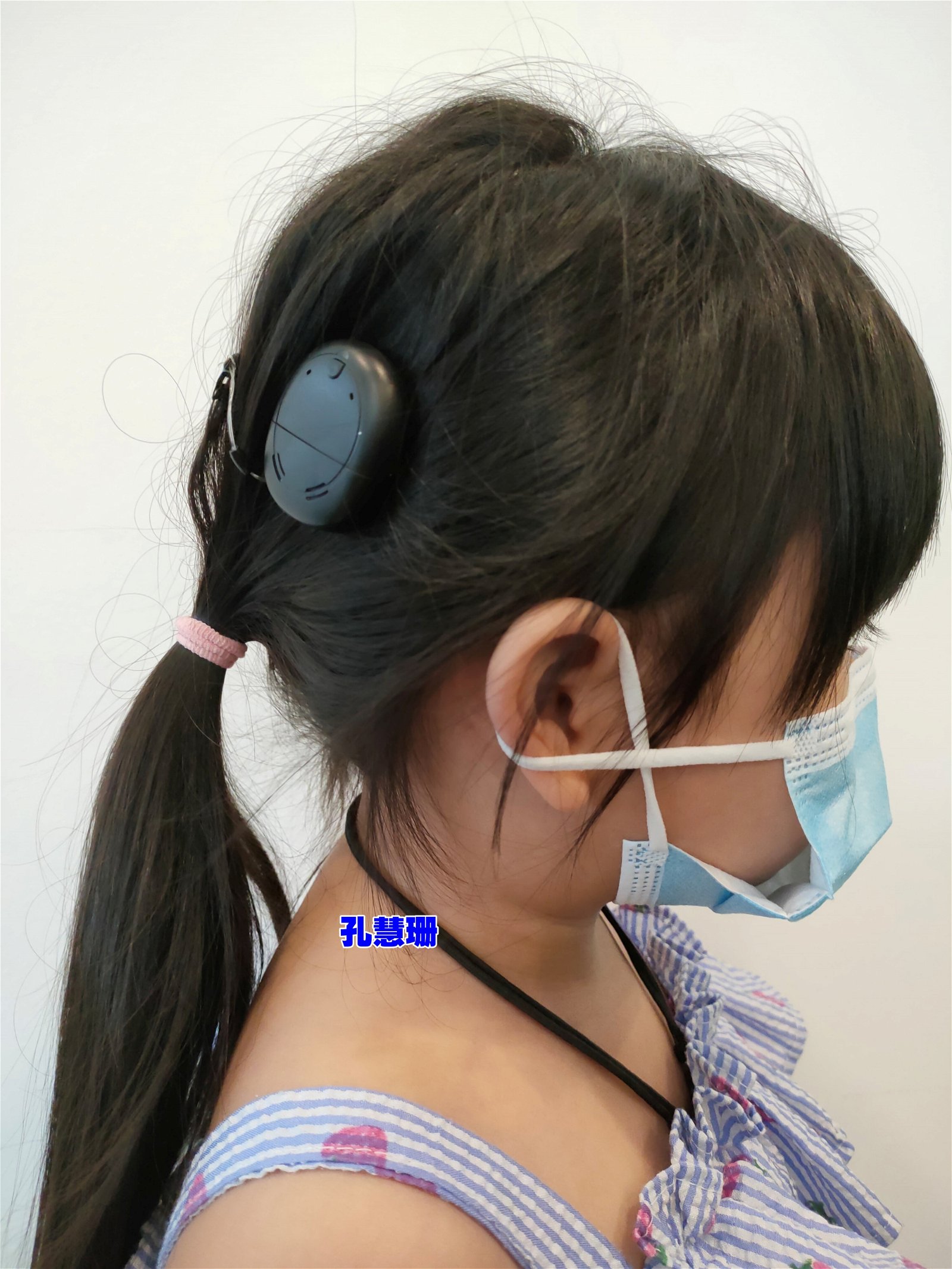 张嘉恩的左耳在1岁时植入人造耳蜗了，如今需要在右耳植入人造耳蜗。