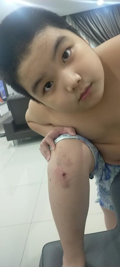 陈政滔上周五骑脚踏车跌伤后，膝盖和腹部都有擦伤。