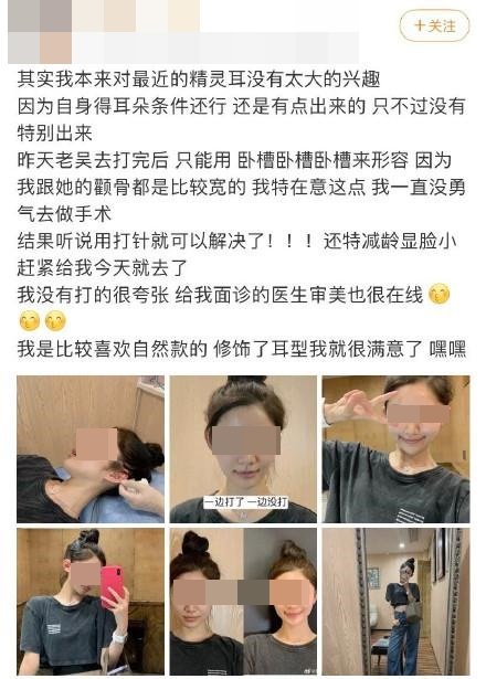 中国网红以打针的方式来修饰耳形并进化成“精灵耳”，并在微博上分享整形的经历，并放出前后对比照，称这样做可以龄显脸小。（图取自网络）