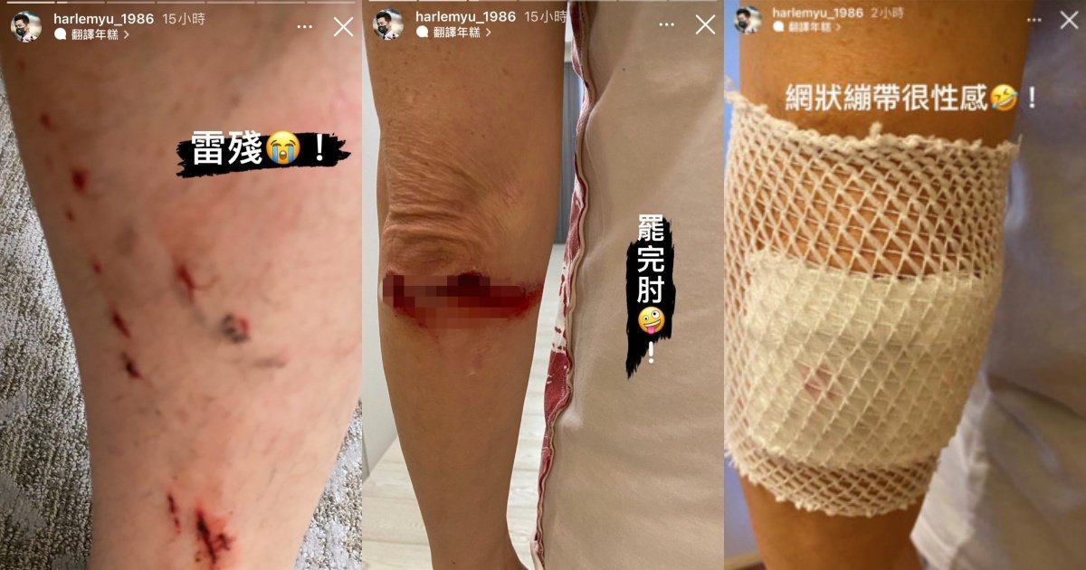 庾澄庆在IG限时动态晒出一连串的受伤照，让粉丝看到后十分担心。