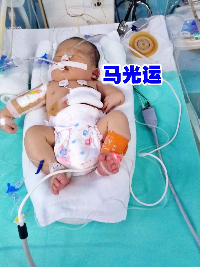 新生儿马光运罹患VACTERL联合畸形症，当务之急需要进行心脏手术保住生命。