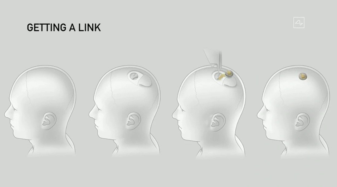 Neuralink这项产品由一个微型装置、电极丝组成，必须切下人类一小块骨头并把它植入脑中，希望能让伤残患者找回沟通与活动能力。（图取自Neuralink网页）