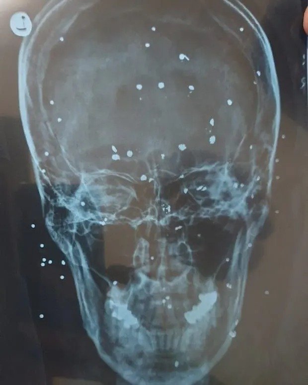 由伊朗医务人员提供的X光图像显示，伤者的头颅周围环绕著无数霰弹弹丸。（卫报）