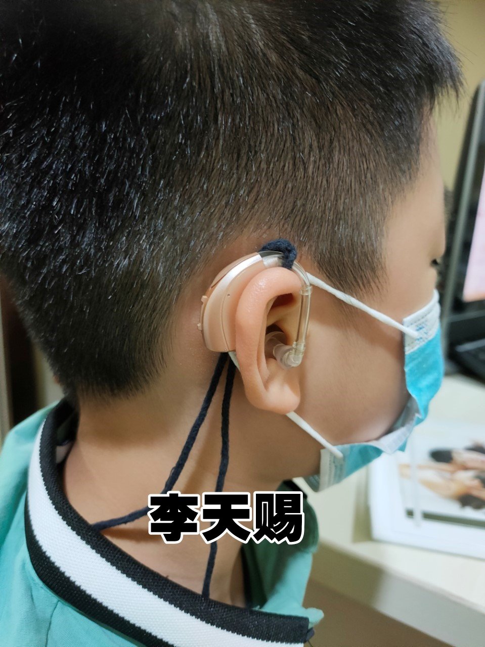 李天赐左耳全聋，右耳仅剩三成听力，所以左耳需要植入电子耳蜗。