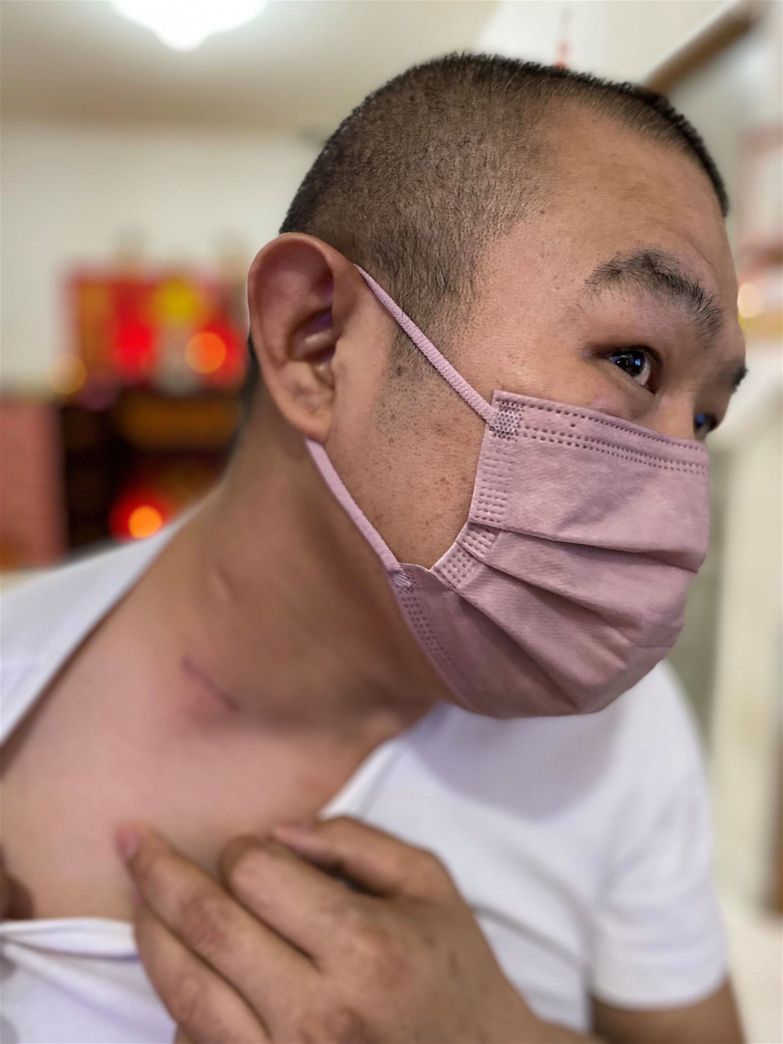 傅敦龙于2019年脖子上突然肿胀长了一个包，割除检验后被诊断患上淋巴癌第三期。