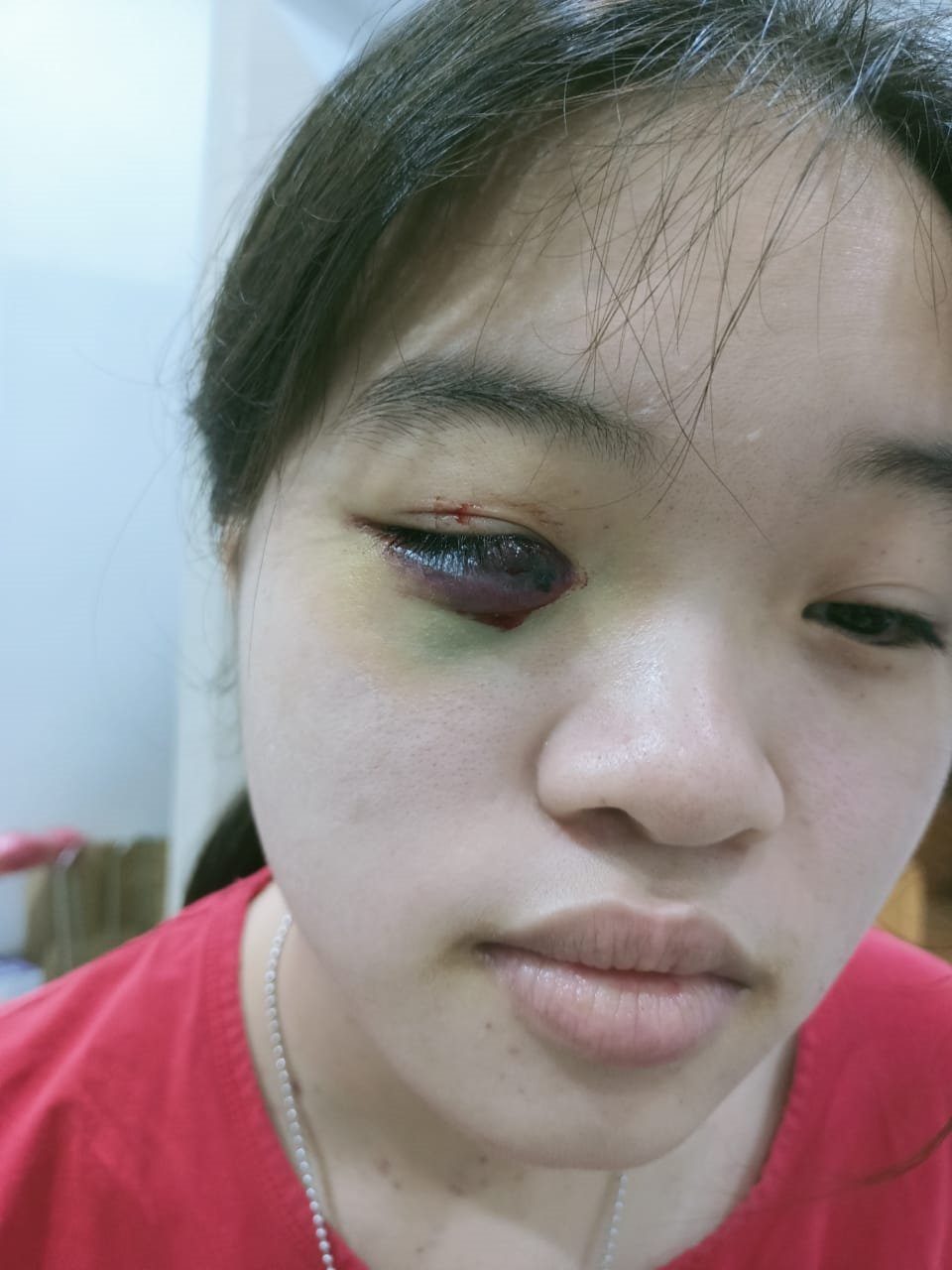 赖培怡的眼睛周围于去年年尾莫名出现淤青，犹如被人殴打一般。