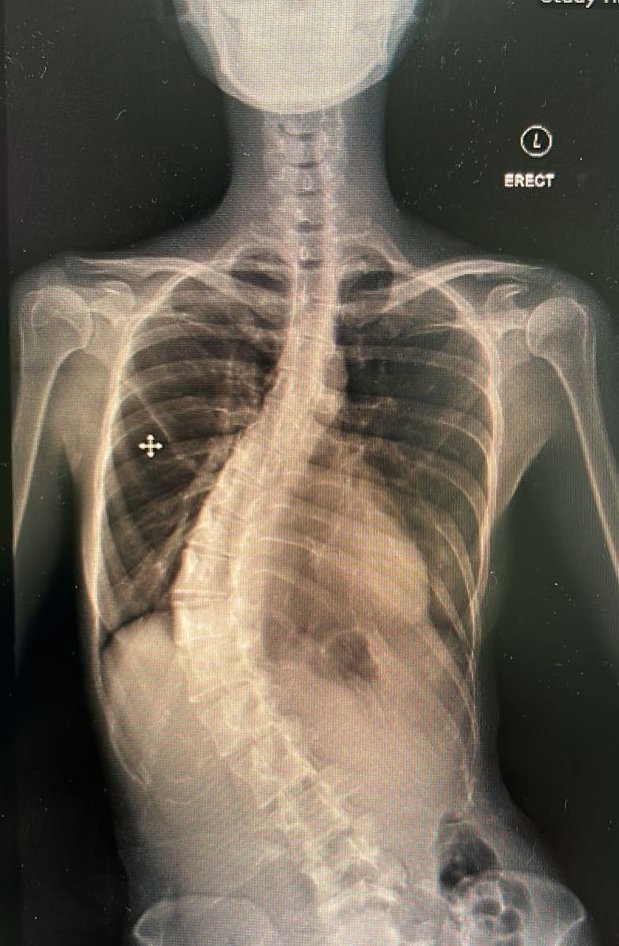 陈家敏的脊椎X光片。