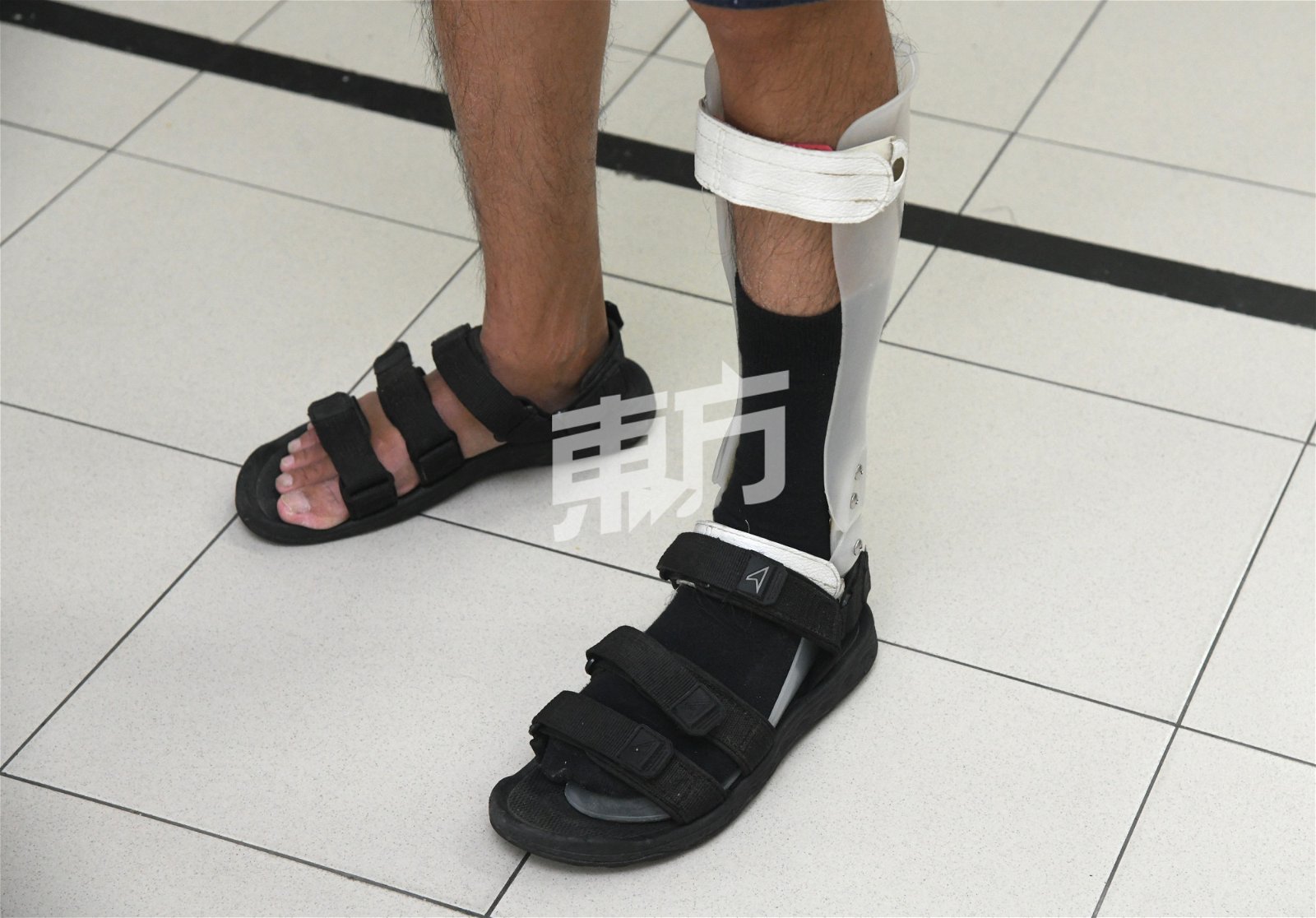 由于脚掌仍然不受控制，丁伟恩只能穿上特制的鞋子，在走路时能协助他把脚掌擡起来。