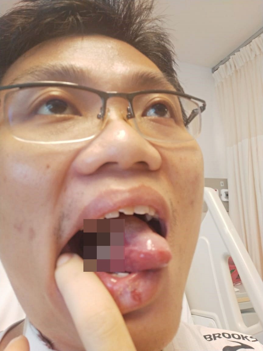 邓闳升右边舌头时常溃疡，检验证实患上舌癌。