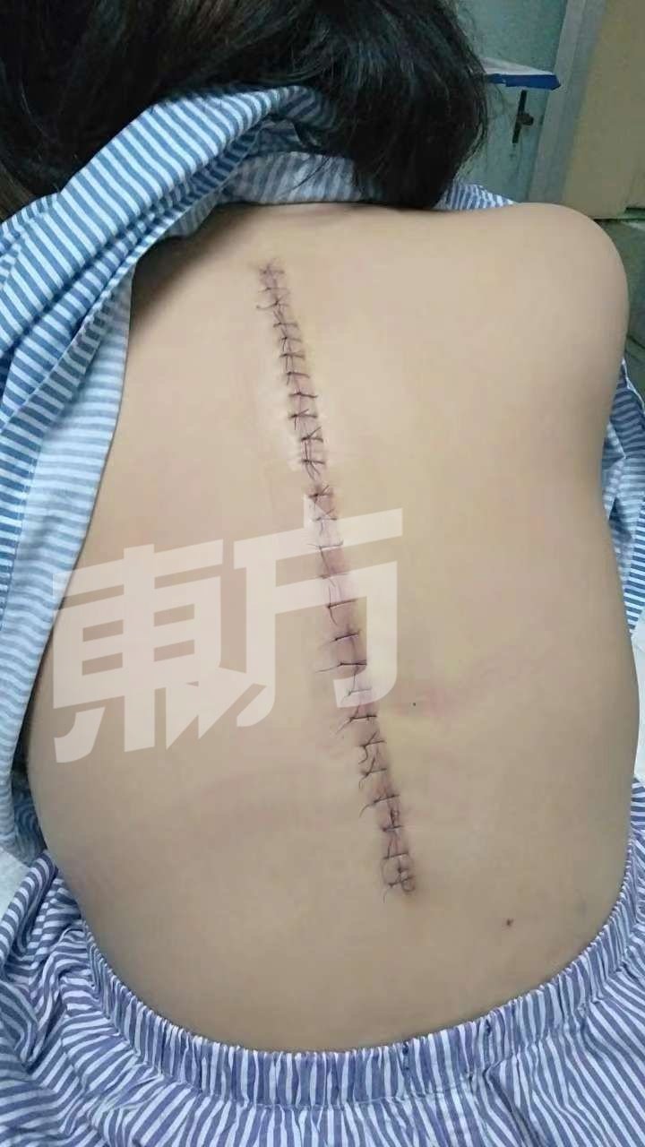 蔡荔珺在2022年6月动了脊椎骨手术后所拍摄的背部情况。（叶银珠提供）