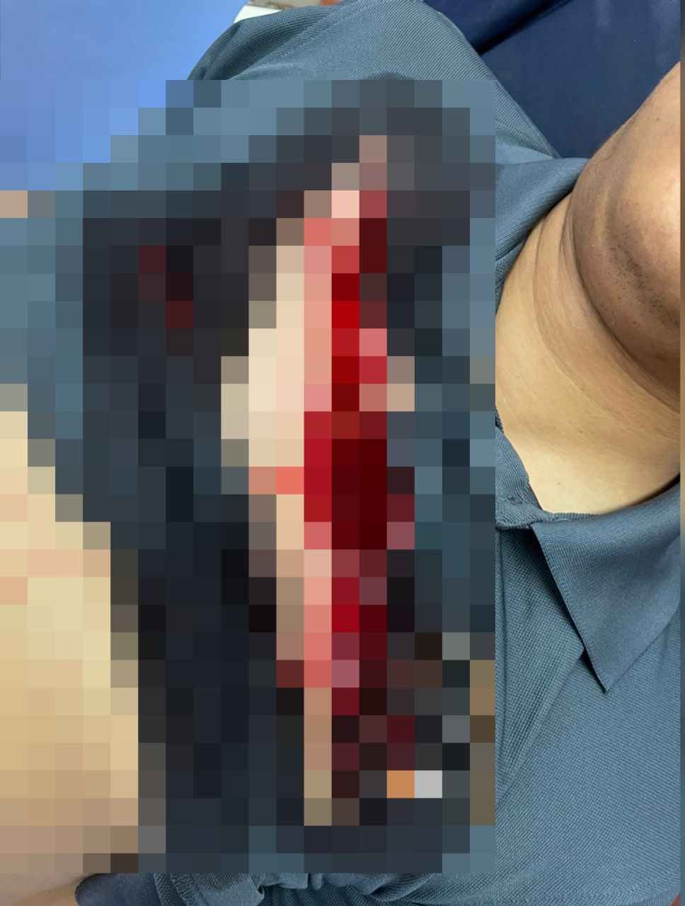 一名警员的胸口被割伤，鲜血直流，共缝了36针。