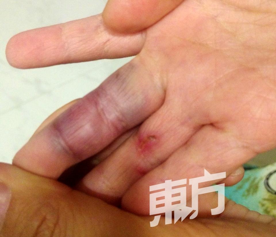 孩子癫痫发作时，紧握拳头，导致手掌淤青受伤。