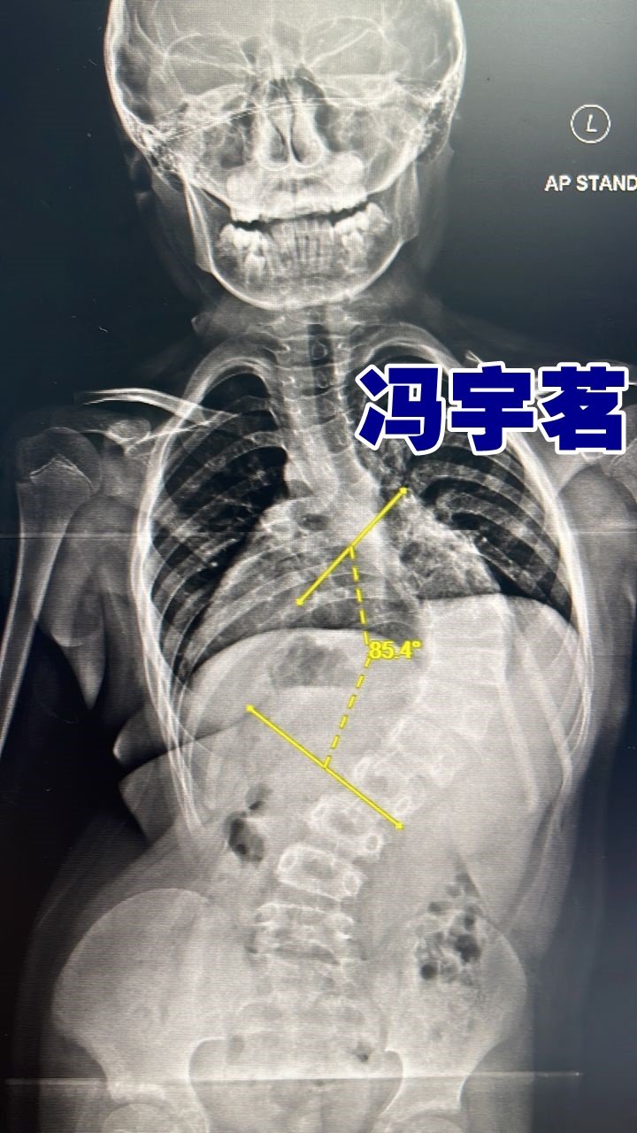 冯宇茗的脊椎X光片。