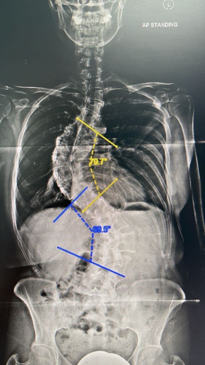 陈芊宇脊椎X-光照。