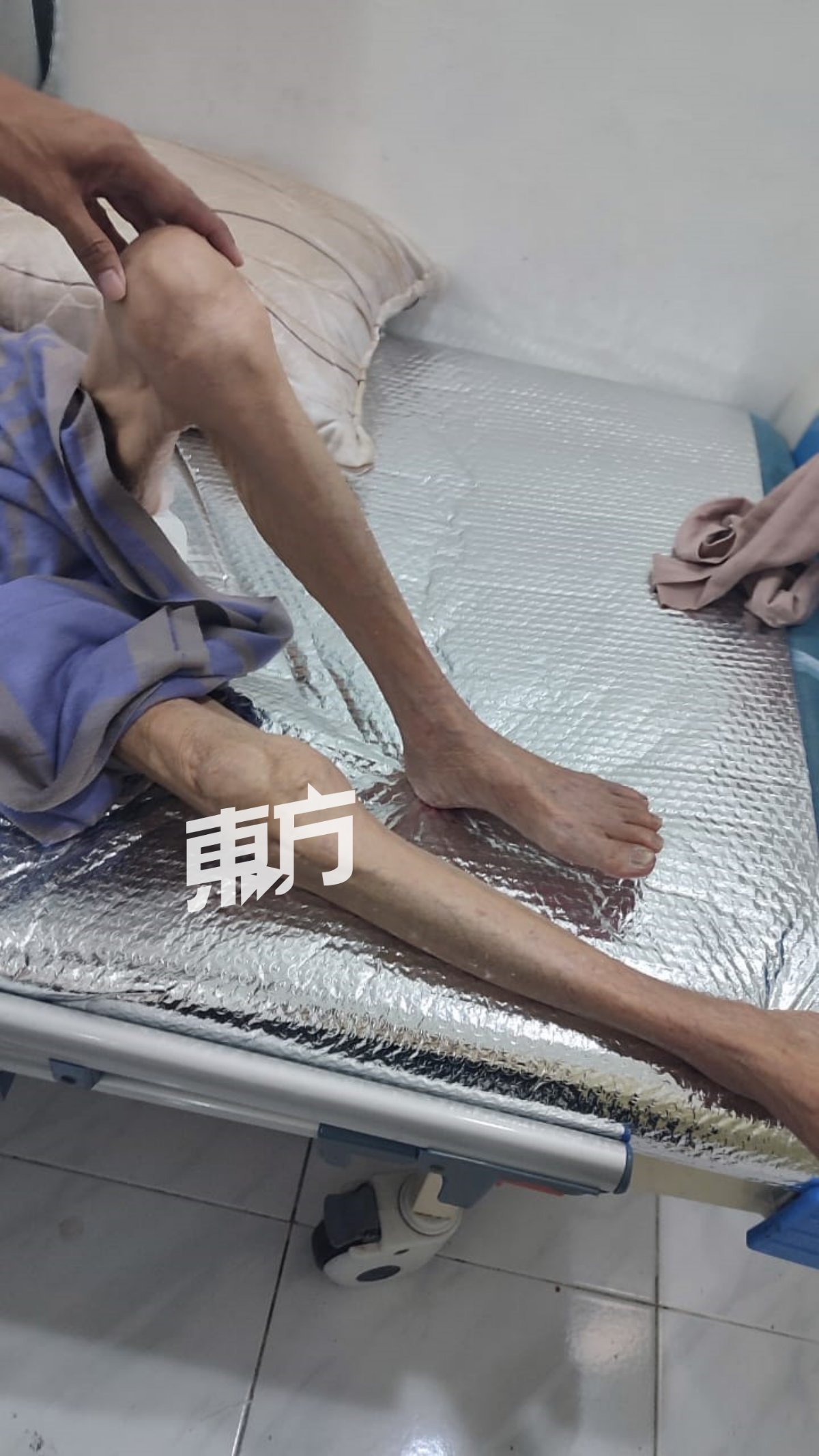 张广权母亲的其中一只脚的关节已出现硬化现象。