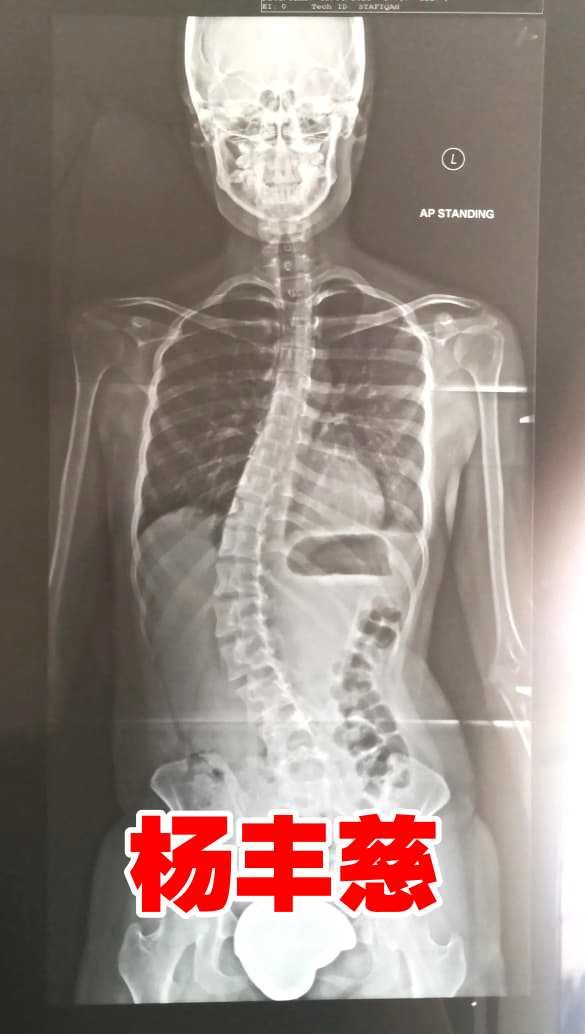 杨丰慈的脊椎X光片。