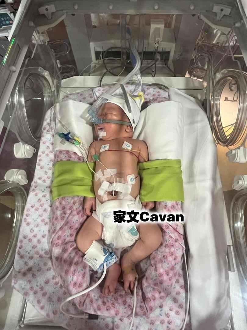 男婴家文（Cavan）肺部发育不全，需要在加护病房靠著氧气及药物辅助治疗两周。