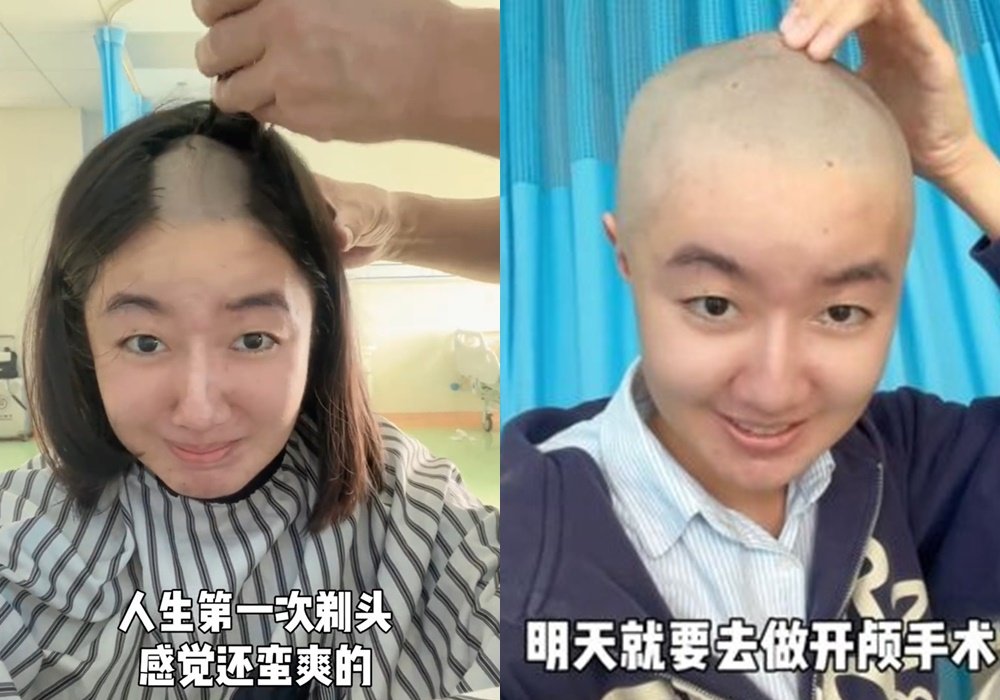 高君雨近日透露自己罹患罕见脑瘤，并公开术前的剃光头影片。