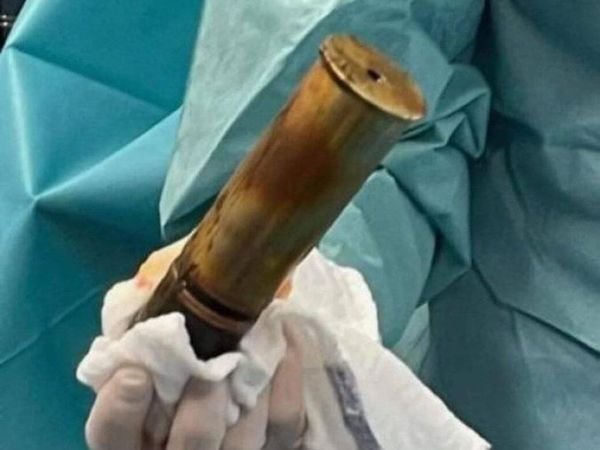2022年法国一名88岁男性在肛门里插入一枚一战时期的炮弹。