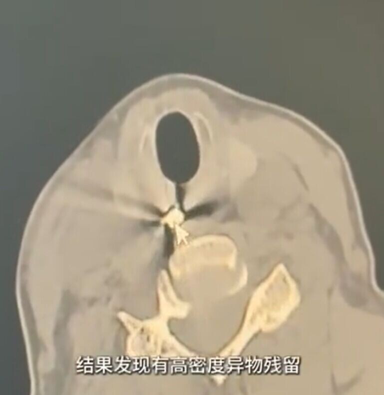 CT扫描显示，豆浆机脱落的金属刀片卡在病患喉咙。