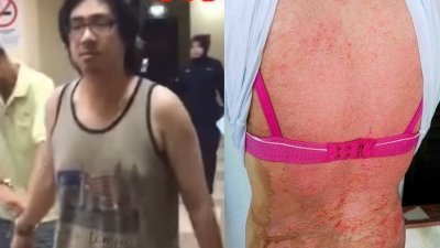 阿盈指遭30岁男友阿伦(左图)以沸水烫伤背部，当时她还让媒体拍摄其背部的伤痕。（档案照）