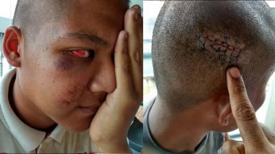 安南的眼睛及脸颊被打至红肿，头部也缝了7针。