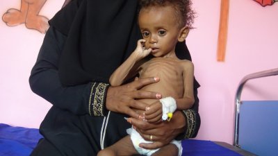 也门的3年内战导致生灵涂炭，平民成了最大的受害者。在也门西部省份一村庄，一名母亲抱著她营养不良的孩子在医疗中心等候治疗。