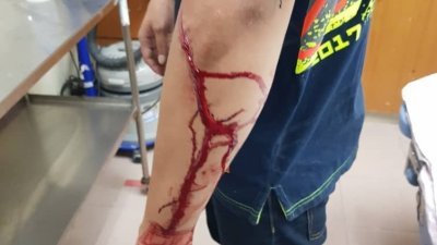 嫌犯拒捕并以鹰爪刀割伤警员的手臂，所幸警员伤势不严重，受伤警员治疗后已出院。