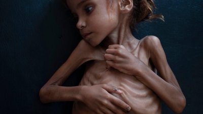 因内战引发饥荒而变得骨瘦如柴的7岁也门女童阿玛尔，引发国际社会关注也门内战和饥荒。
