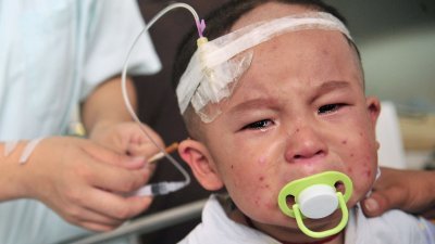 2008年9月23日，中国安徽省一名因食用含有三聚氰胺奶粉而患上肾结石的两岁孩童，在合肥医院接受治疗。当时有高达30万幼童因此患上肾结石及泌尿科疾病，至少6名幼童死亡。事隔10年，这批结石宝宝健康状况仍存疑。