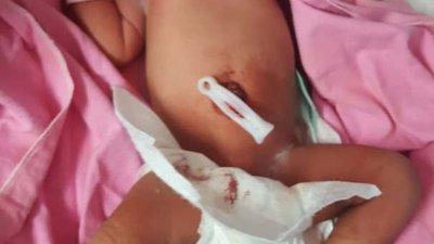 女婴被发现时脐带未断，被 包裹在一块峇迪布中。