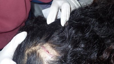 女子遭丈夫以熨斗攻击头部，导致头部出现3公分的伤痕。