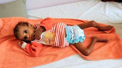 一名营养不良、瘦骨如柴的也门孩童躺在首都萨那一间医院的病床上。多个联合国组织日前发布报告指，零饥饿目标正面临巨大挑战，许多经济增长放缓的国家，饥饿水平正在上升。