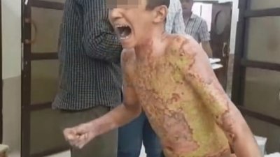 视频中，一名疑似被白磷弹严重烧伤的库族男孩，痛苦地大声喊著“爸，让灼痛停止吧，我求你！”。