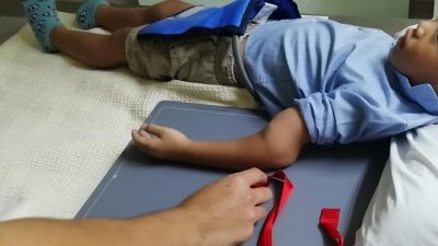 男童的手肘严重骨折，需即时安装固定器。（图取自男童母亲面子书）