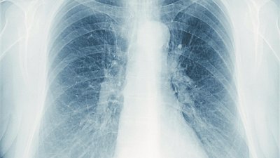 咳嗽是肺痨病的症状之一，若民众咳嗽超过2周，应到附近医院进行肺痨检查。（图取自网络）