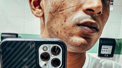 前线医疗人员班杰明王（译音）分享长时间戴口罩等防护措施后，在脸上留下疤痕的自拍照。（图取自面子书）