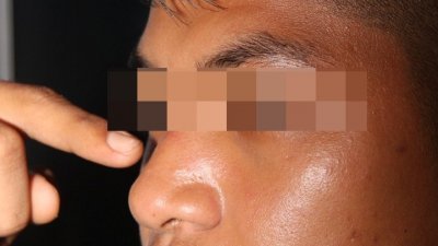 警员的鼻梁遭一名涉毒华裔男子挥拳打伤。