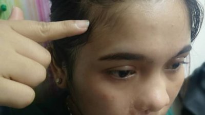 印尼女子指著被嫌犯捉头撞床角所伤及的额头。