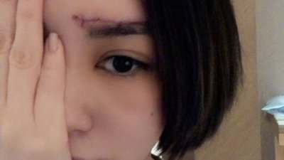 阿娇首度在微博上传伤口的照片，只见其额头有一条长长如蜈蚣般的缝线伤口。
