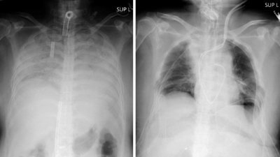 手术前（左）两侧肺脏呈现白色、没能发挥功能的状态；手术后（右），肺脏在X光片上已呈黑色，可正常发挥功能。