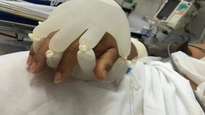 护士细心把装满温水的一双手套，套在病患的手上，让病患感觉一直被家人握住，冀望借此支持病患继续为生命奋斗。（图取自public health malaysia）
