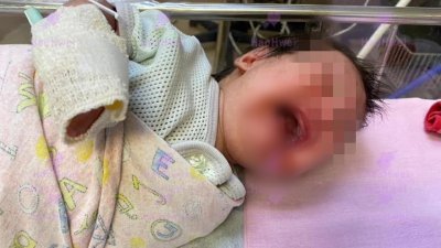 女婴疑因陪月中心疏忽照料，导致二级烫伤。