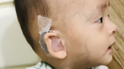 陈垂宇双耳佩戴助听器一段时间后，仍无助他的听力。