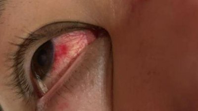 24岁男子眼睛血管爆裂。（受访者提供）