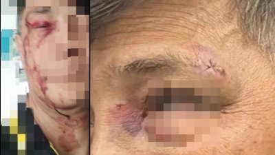 伤者的同事在社交媒体发布照片，指其同事脸部被对方打伤至淤青及缝针。