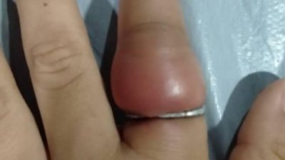 男童被戒指卡住的左食指，严重肿胀。