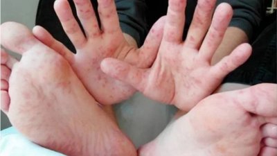 柔州累计6987宗手足口症病例，多达6048宗（86.6%）病例是6岁以下的儿童。（档案照）
