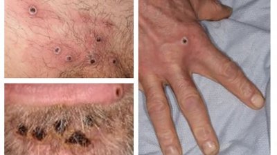 英国卫生安全局周三提供猴痘皮疹病变的图片，日期和地点未公开。（图取自英国卫生安全/法新社）
