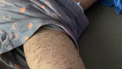 马登巴冷县卫生局已针对社交媒体流传，一名男童在温泉沐浴后起皮疹一事展开调查。（图取自艾丽法拉推特）
